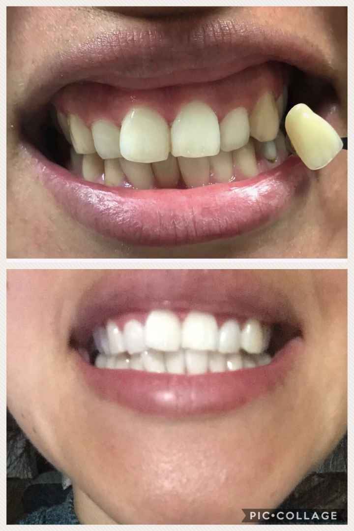  Blanqueamiento dental - 1