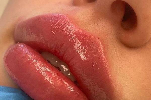 RELLENO DE LABIOS