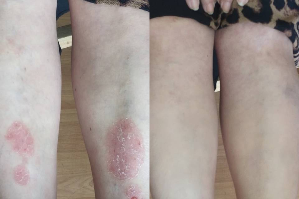 Camuflaje psoriasis