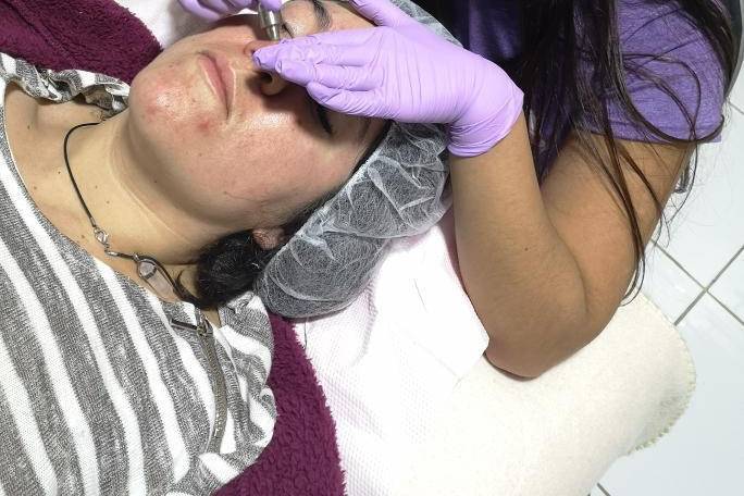 Limpieza facial