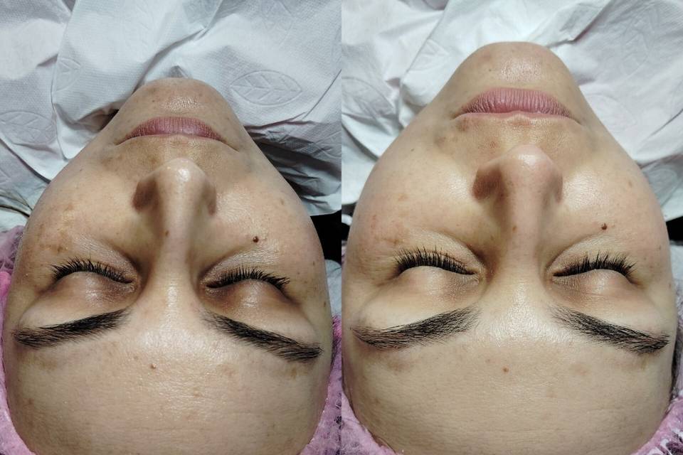 Hidratación Facial