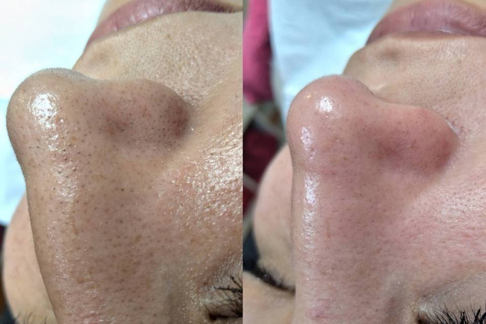 Limpieza facial profunda