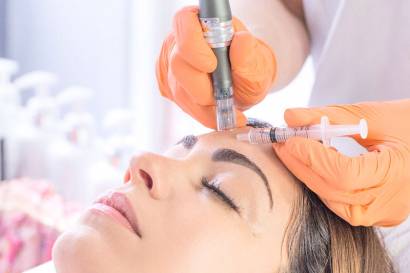 Microneedling