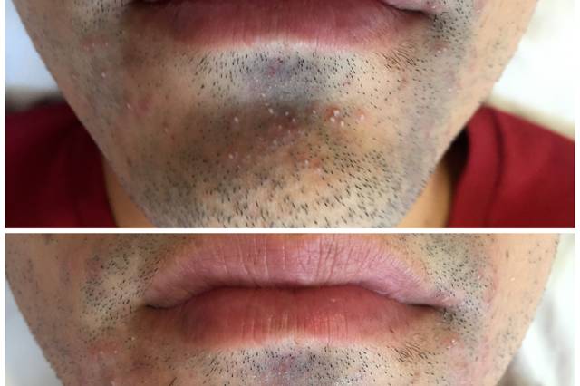 Limpieza facial masculina